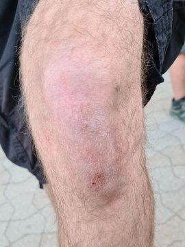 verletztes Knie