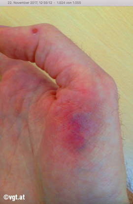 Violett angeschwollene Hand